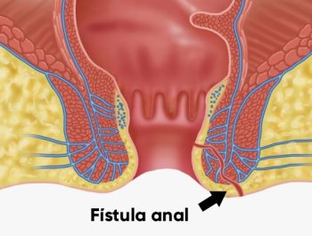 perianal-o-que-sintomas-e-quando-fazer-cirurgia perianal-o-que-sintomas-e-quando-fazer-cirurgia